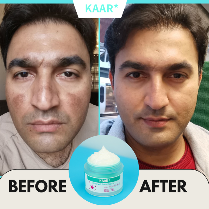 KAAR Renewing Cream – Fade Stubborn Spots in Just 14 Days! ⏳ Hurry, Sale Ends Today!